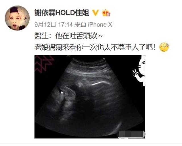 谢依霖怀孕八个月了妊娠纹有点吓人这么耿直的女艺人你见过吗