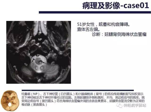 舌下神经解剖影像及临床