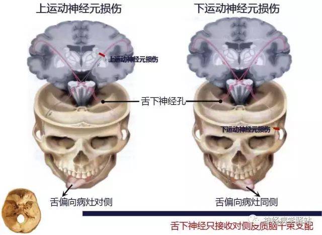 舌下神经解剖,影像及临床