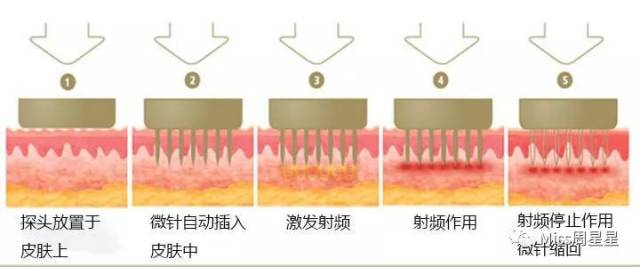 黄金微针不是激光,是通过微针针头刺入皮肤以后在皮肤里面加入射频的