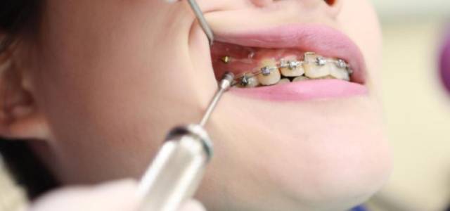 牙科医生告诉你:牙齿矫正为什么需要打支抗钉?