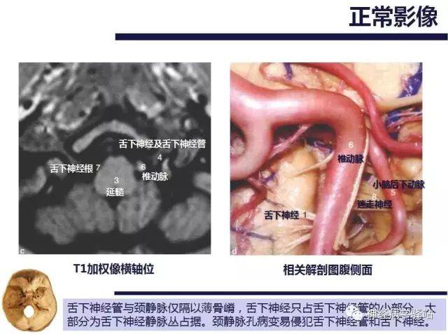 舌下神经解剖,影像及临床