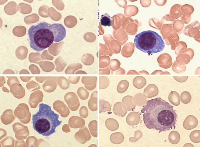 造血干细胞→淋系干细胞→b淋系祖细胞→b原淋巴细胞→b幼淋巴细胞→b