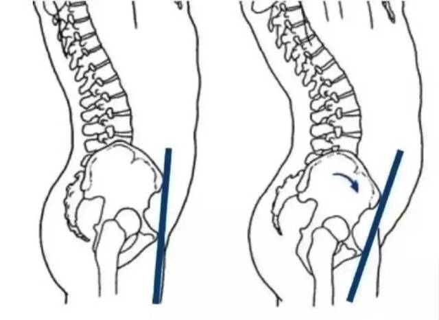 可以对比一下正常骨盆和骨盆前倾的体态区别