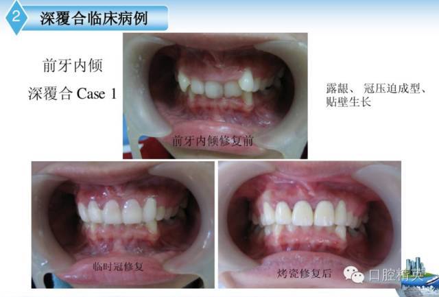 前牙深覆合深覆盖修复治疗