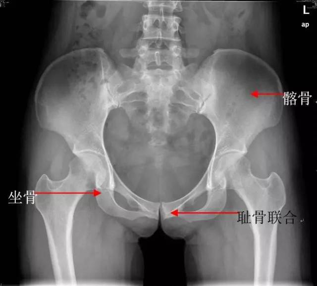 2)骨盆骨折:多为强大的外力所致,发生率较低而病死率较高.