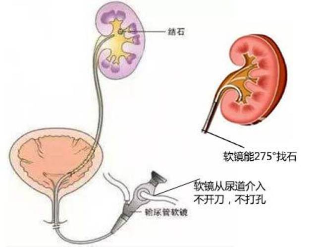 伤不起的肾结石 不止是疼痛而已