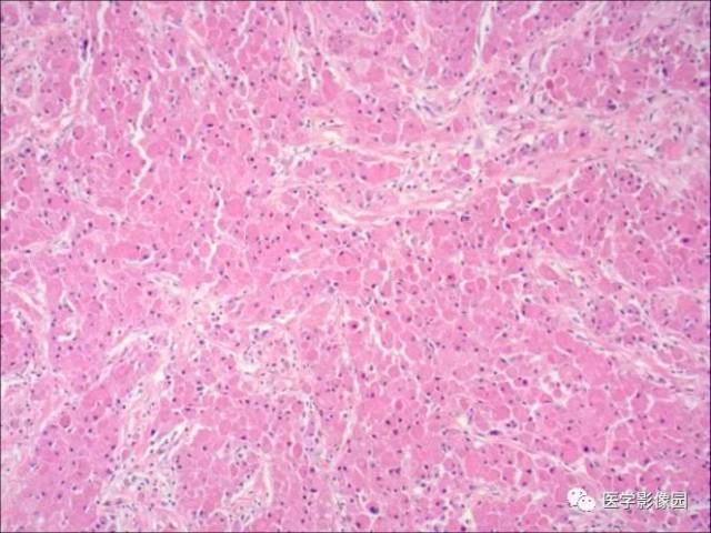 恶性颗粒细胞瘤10例临床病理学观察及文献复习[j].