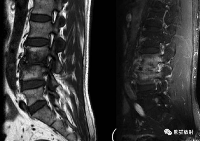 脊柱结核和非结核性脊柱炎丨mri鉴别诊断