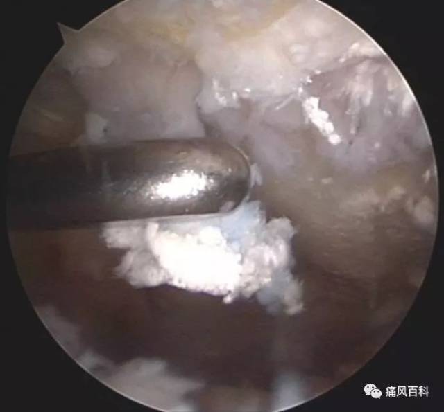 不同病情阶段痛风石的临床表现和诊疗