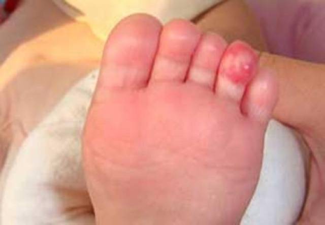 宝宝脚上长了血管瘤怎么办脚上长了血管瘤需要治疗吗