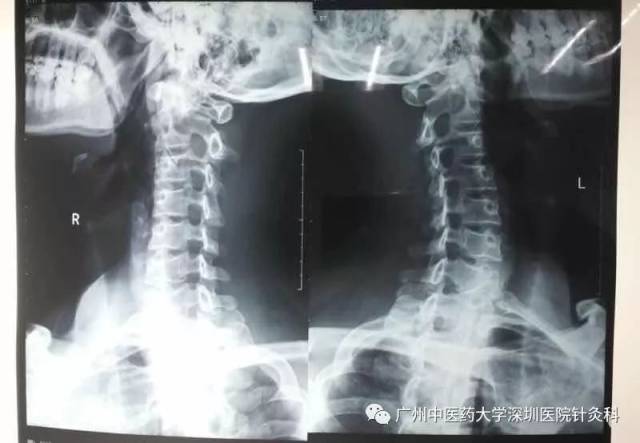 名医有约你知道吗手麻可能不是颈椎病引起的