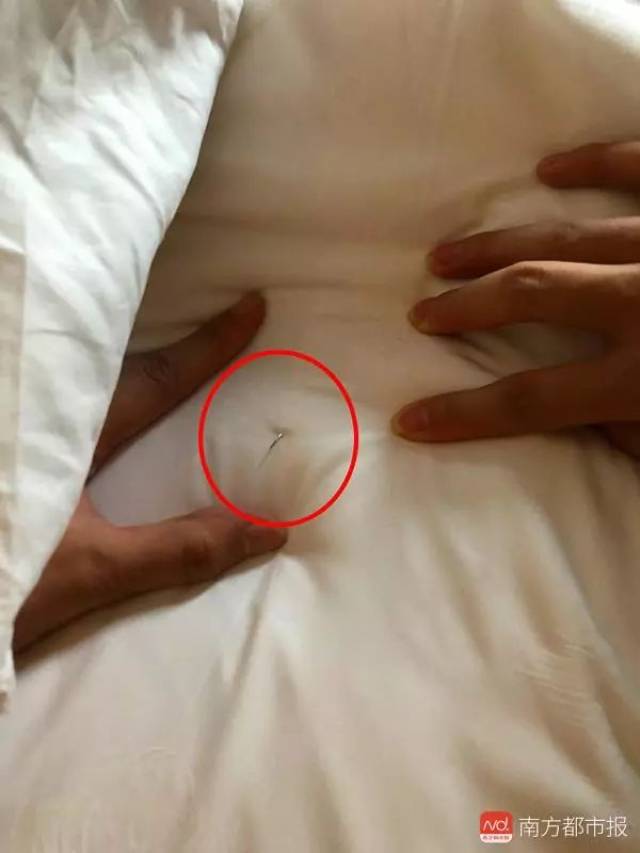 酒店床上有根立起的针 女子大腿被扎出血