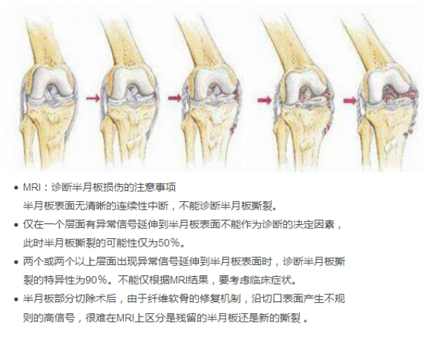 时可引发交锁,轻度积液,关节线压痛,股内侧肌萎缩, mcmurray试验阳性