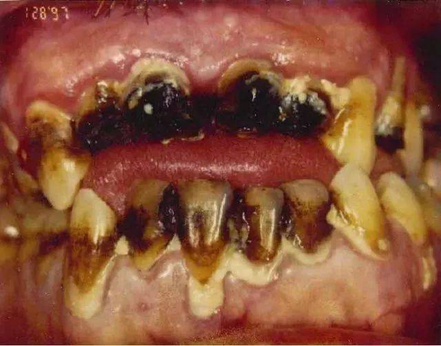 不仅是牙齿 吸毒还会毁坏吸食者的皮肤和五官 ▽▽前方继续高能▽▽