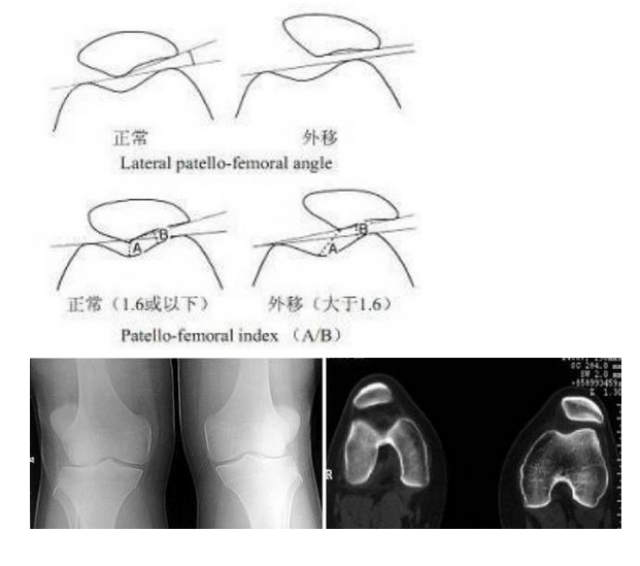 轻度积液,中,重度积液说明有关节内血肿,提示髌骨脱位伴骨软骨骨折和