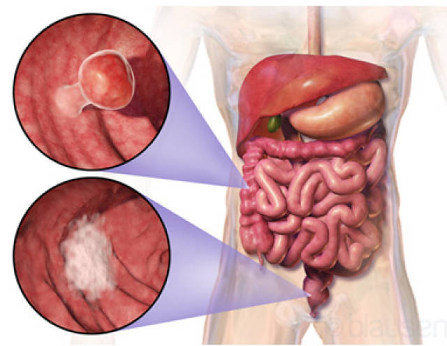 直肠癌的早期症状