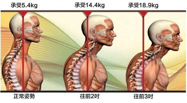 缓解颈部僵硬的5个自然疗法