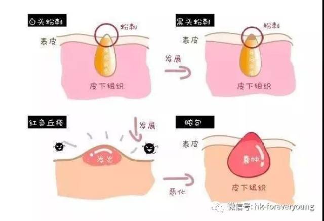 闭口粉刺是什么怎么处理