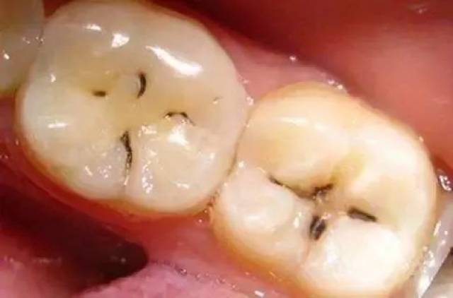 你发现牙齿上黑线了吗?不注意就离拔牙不远了!