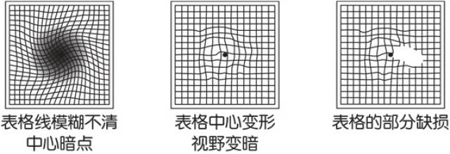 05 黄斑变性测试 手机平举,与眼睛保持30厘米的距离聪下图.