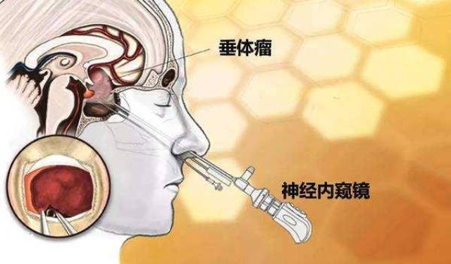 喜欢找年轻人的脑垂体瘤一般有如下四大早期症状,快来看看