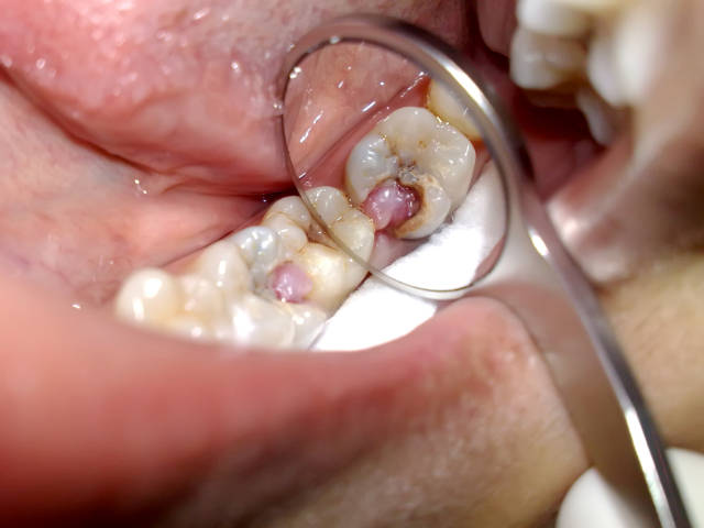 可逆性牙髓炎与不可逆性牙髓炎有什么区别?