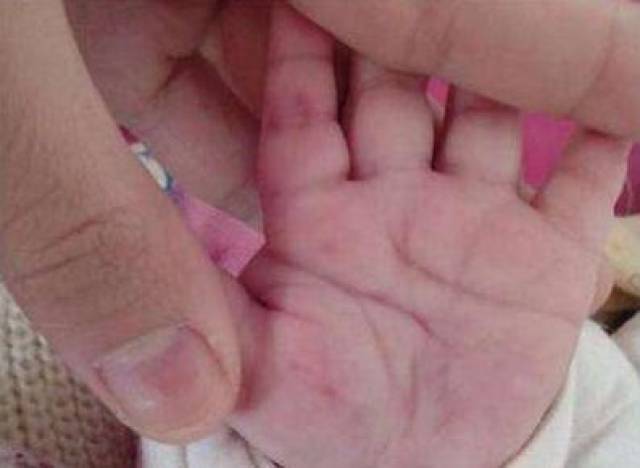 1,食指发紫 孩子食指上有三个穴位,这三个穴位也是孩子脾胃的反射区