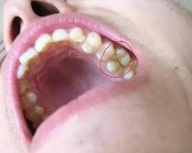啃螃蟹致牙隐裂你该怎么保护脆弱的牙齿呢