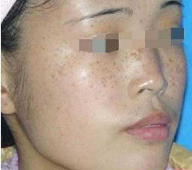 三十五岁以后的女性偏多,身体原因占主要部分,黄褐斑一般面积比较大