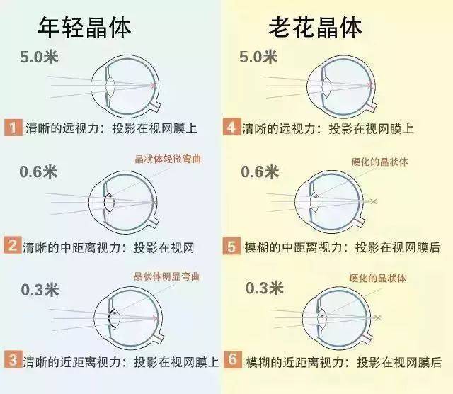 【锦医科普】人到中年,眼睛近视又老花,怎么办?