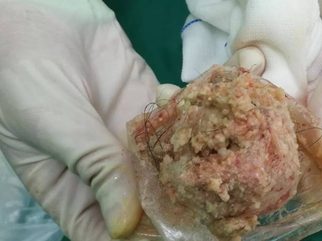 【涛声no.5】卵巢肿瘤的奇葩——畸胎瘤