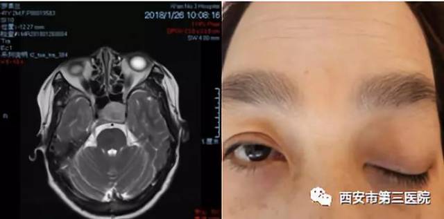 近期西安市第三医院神经外科收治了2位垂体瘤合并动眼神经损伤的病患.