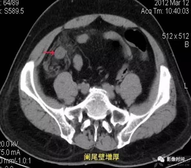 阑尾增粗,扩大,横径超过 6 mm,明显者可超过 10 mm 以上.