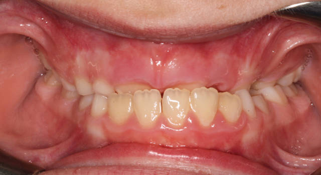 水平开咬——overjet:正常咬合时下颚门牙接触不到上颚门牙,上下门牙