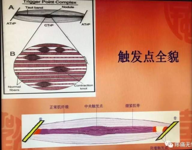 现场报道: 首届上海肌筋膜触发点mtrps技术初级研修班
