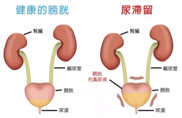 按病因可分下丘脑性和肾性两类 下丘脑性尿崩症 因肿瘤,囊肿,肉芽肿