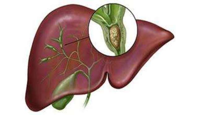 肝囊肿是怎么回事?