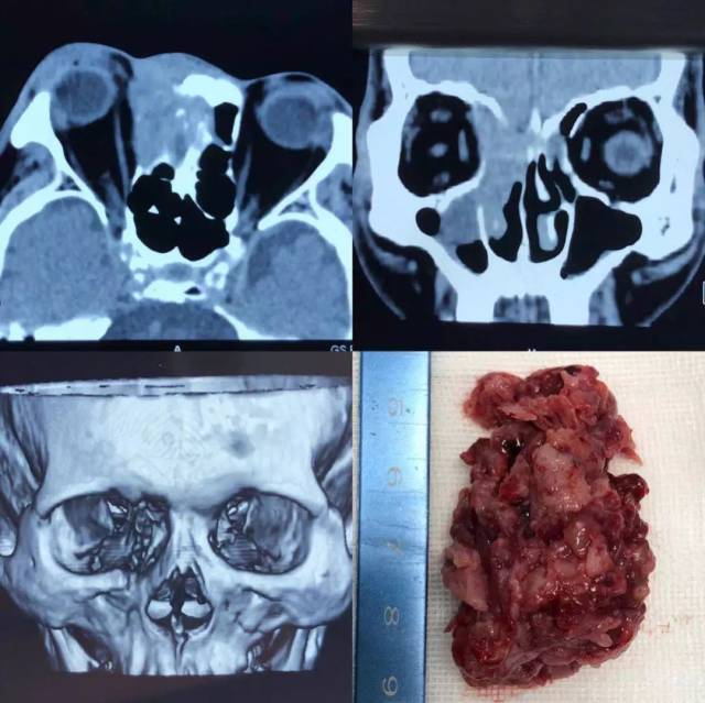 【病例分享】泪囊肿瘤累及鼻眶筛术后功能性修复