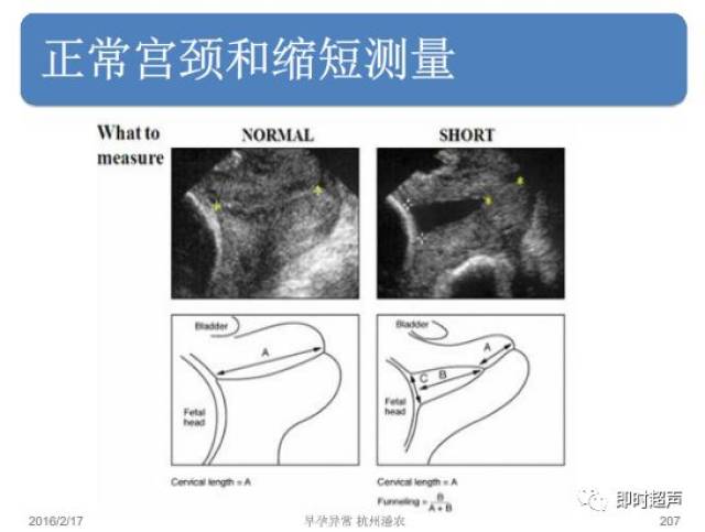 宫颈测量和宫颈机能不全