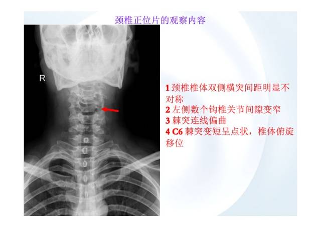 在临床上,颈椎不适最常见的辅助检查就是x片.