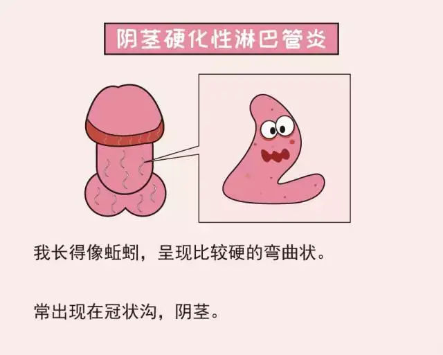 尖锐湿疣,是由人乳头瘤病毒(hpv)感染导致的一种性传播疾病.