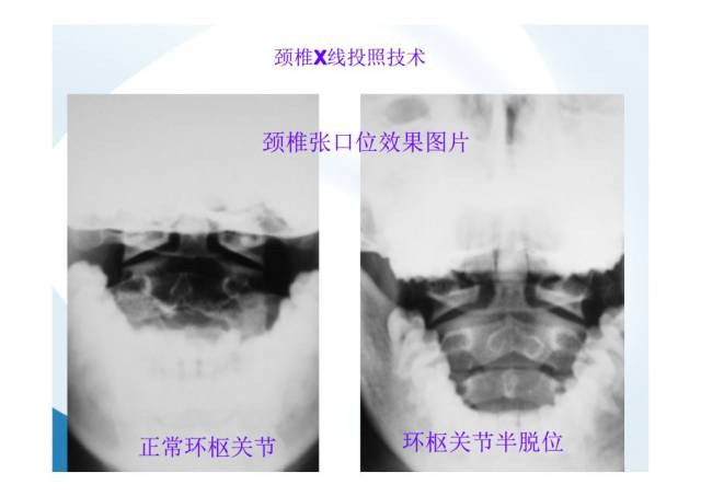 在临床上,颈椎不适最常见的辅助检查就是x片.