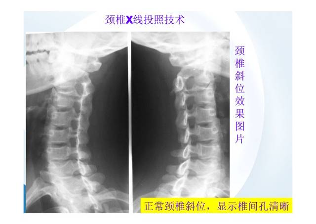 在临床上,颈椎不适最常见的辅助检查就是x片.