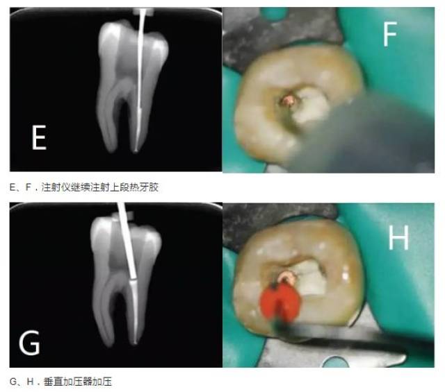 图解:热牙胶充填技术的8个必要操作步骤,你知道吗?