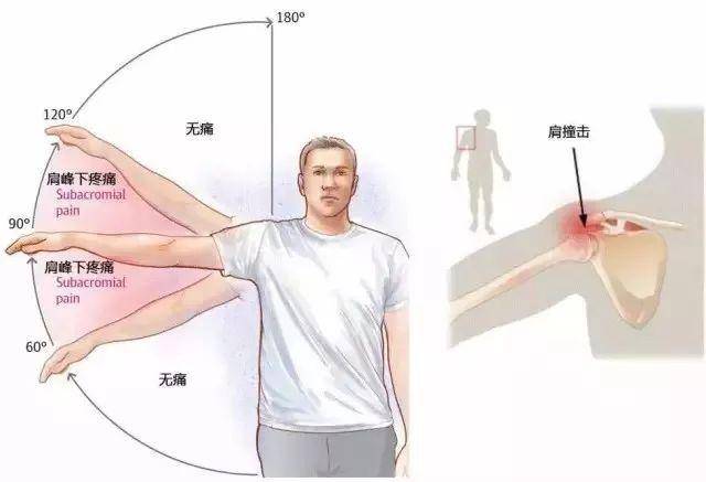 疼痛弧征 部分患者举起手臂60-120度范围之间会出现疼痛或加重疼痛