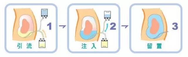 揭阳市首个腹透门诊正式开设——腹透病人的全程随访