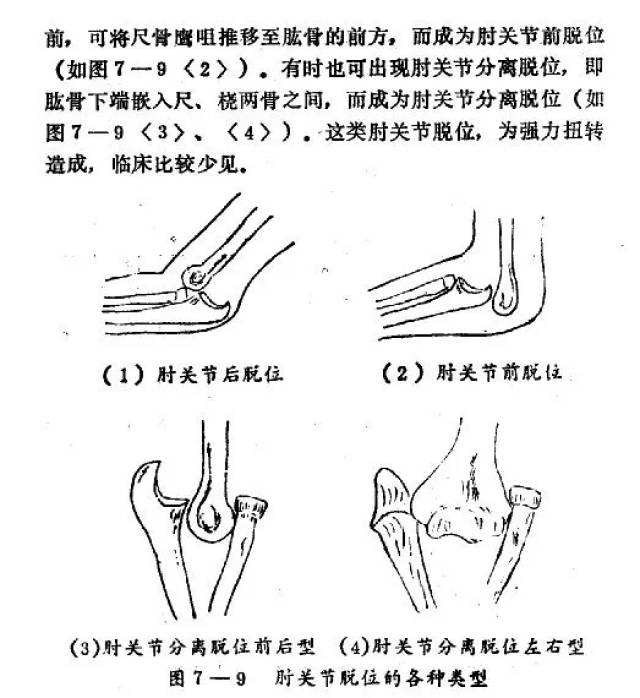 中医正骨手法要诀:肘关节脱位(全程图解)