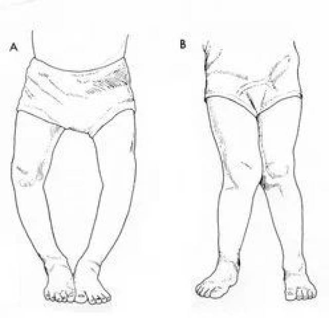 仅仅一周X型腿变直?原来他做了这几个动作
