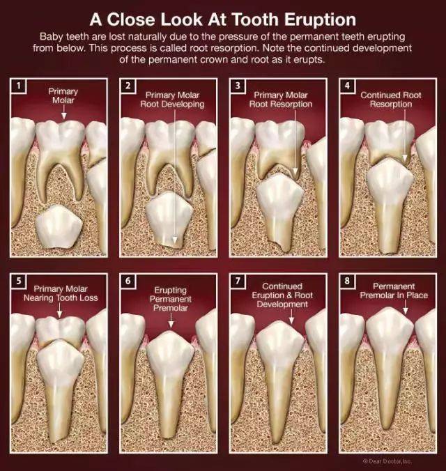 的恒牙失去乳牙的阻挡而过早萌出,早萌的恒牙由于牙根发育长度不足